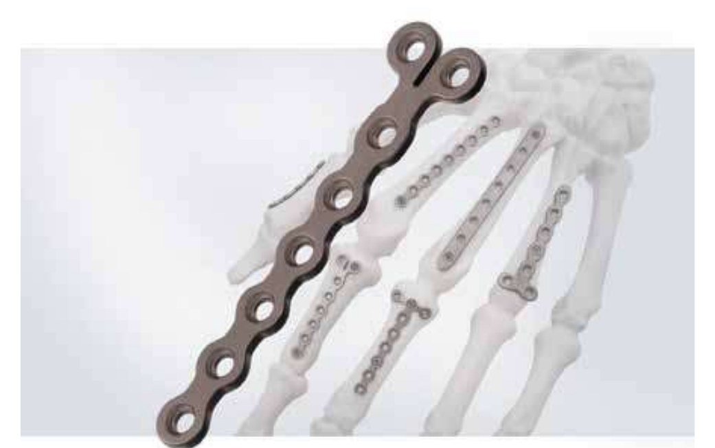 Titanium locking plates fixed to a model of the bones of the hand